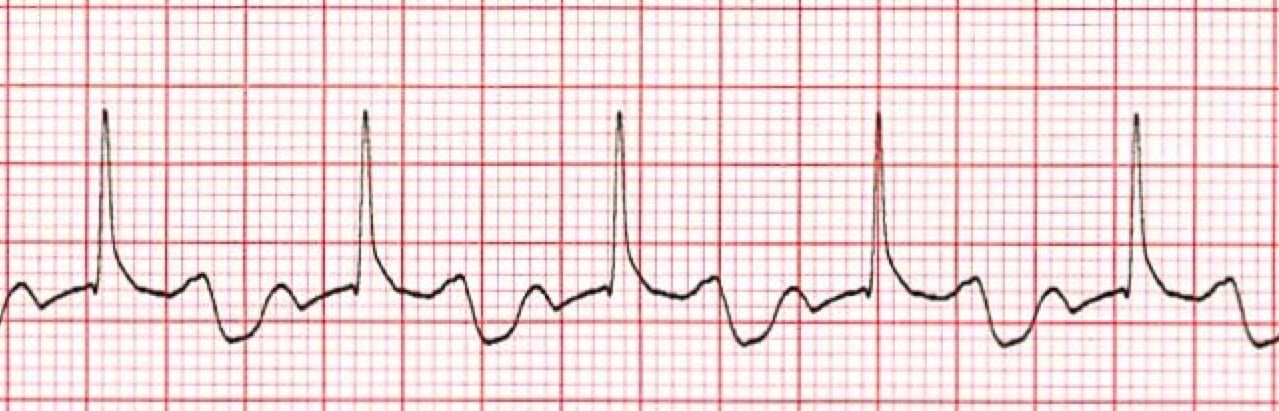 1st Degree AV Heart Block ECG