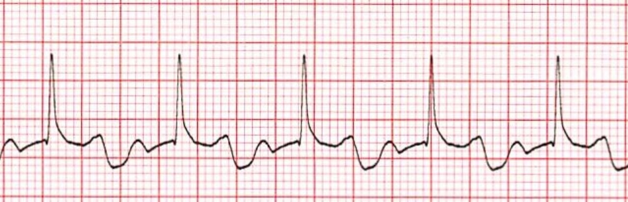 Atrioventricular Block, Heart Block