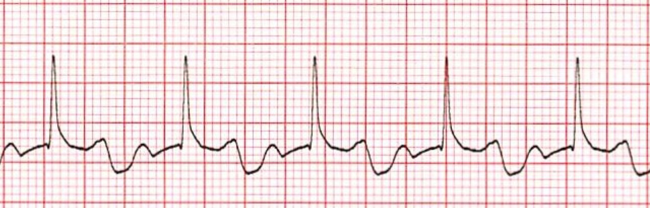 First degree AV Block AV Block I AV Block 1 ECG ECHO 48 OFF