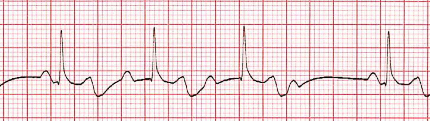 2nd Degree (Mobitz type 1) AV Heart Block ECG