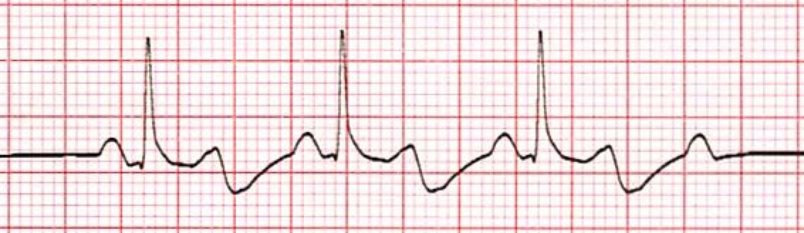 2nd Degree (Mobitz type 2) AV Heart Block ECG