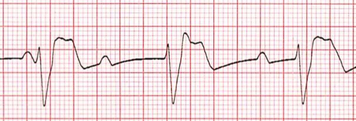 3rd Degree AV Heart Block ECG