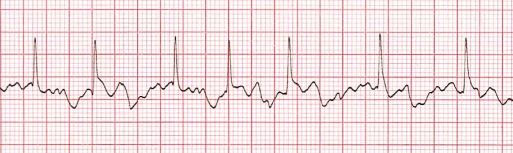 Atrial Fibrillation ECG