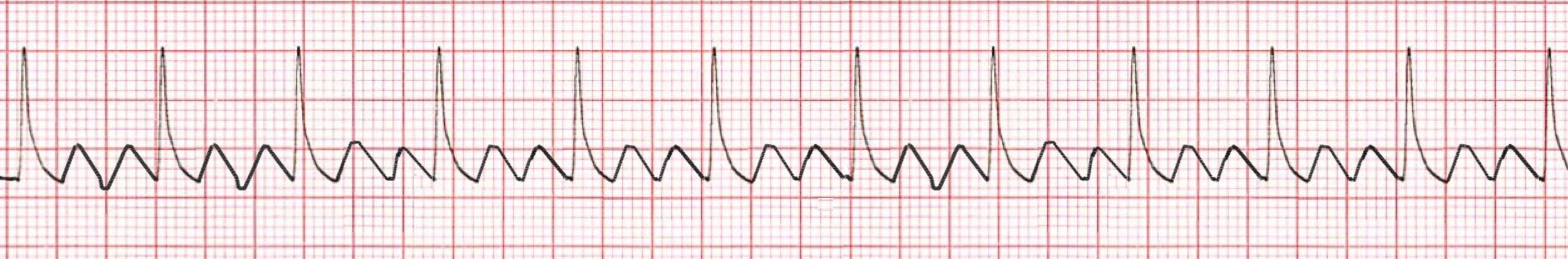 Ekg Atrial Flutter Lbbb