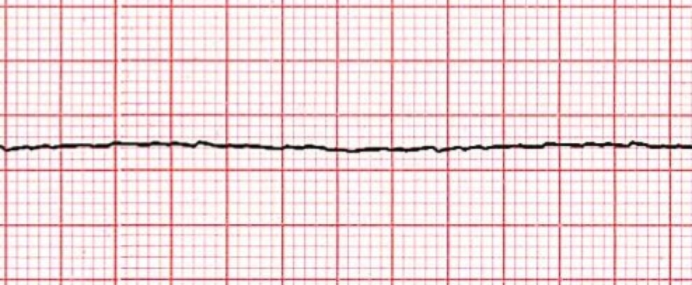 Asystole ECG