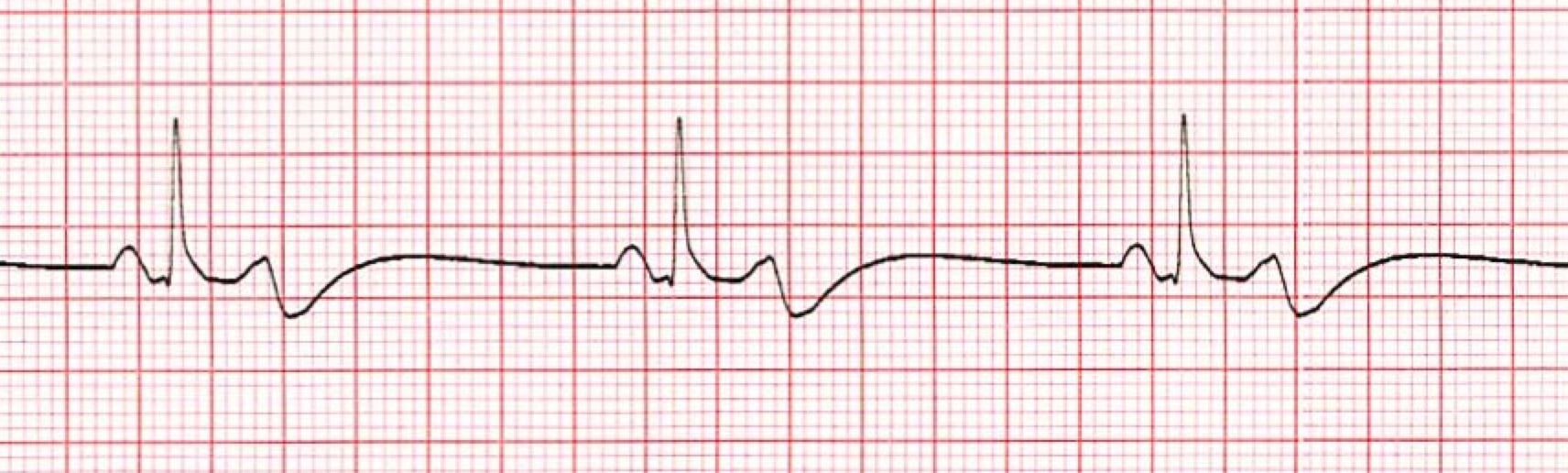 Bradycardia ECG