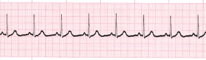 Normal Sinus Rhythm