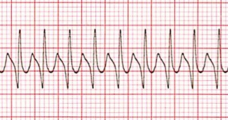 Supraventricular Tachycardia