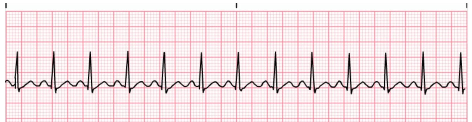 Sinus Tachycardia ECG