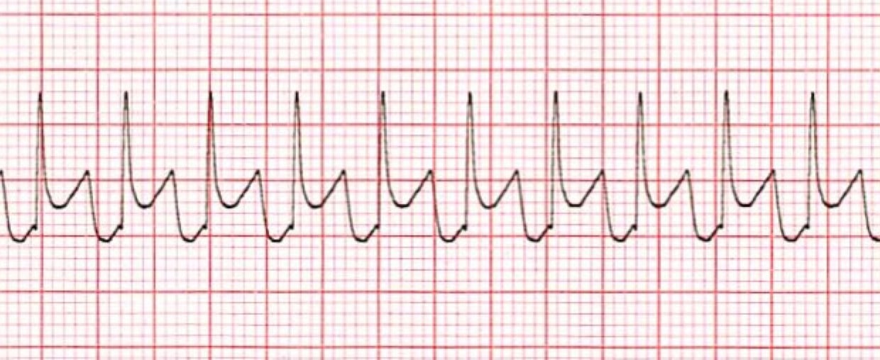 Supraventricular Tachycardia