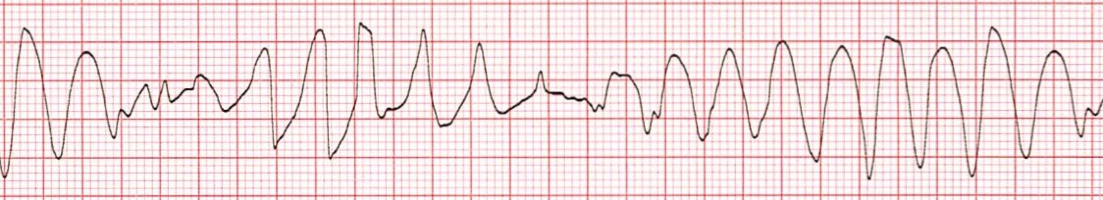 Polymorphic Ventricular Tachycardia ECG