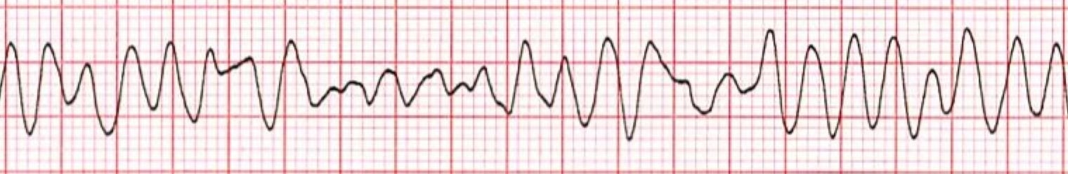 Ventricular Fibrillation ECG