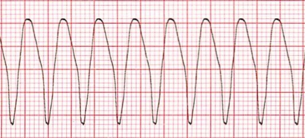 Monomorphic V-tach ECG