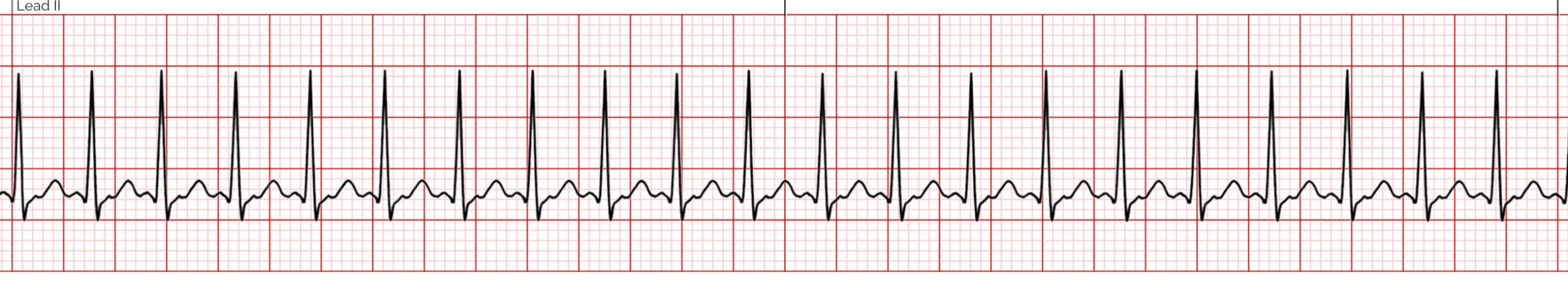 Supraventricular Tachycardia